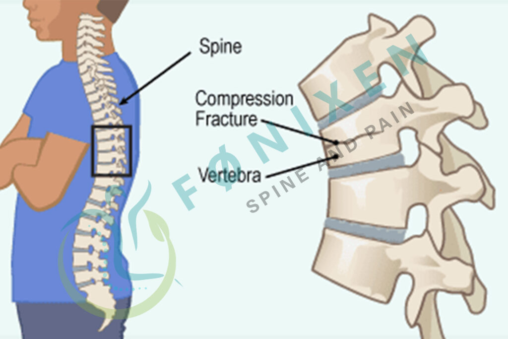 Vertebral Compression Fracture Treatment near me in Hyderabad