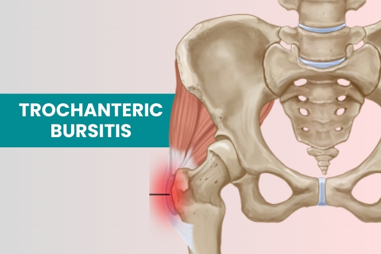 Greater Trochanter Bursitis Greater Trochanteric Pain Syndrome GTPS Greater Trochanter Bursitis Greater Trochanteric Pain Syndrome GTPS