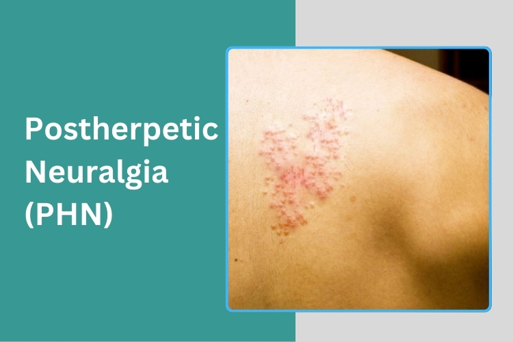Nerve Damage Rash Post Herpetic Neuralgia (PHN) - Fønixen Spine Pain