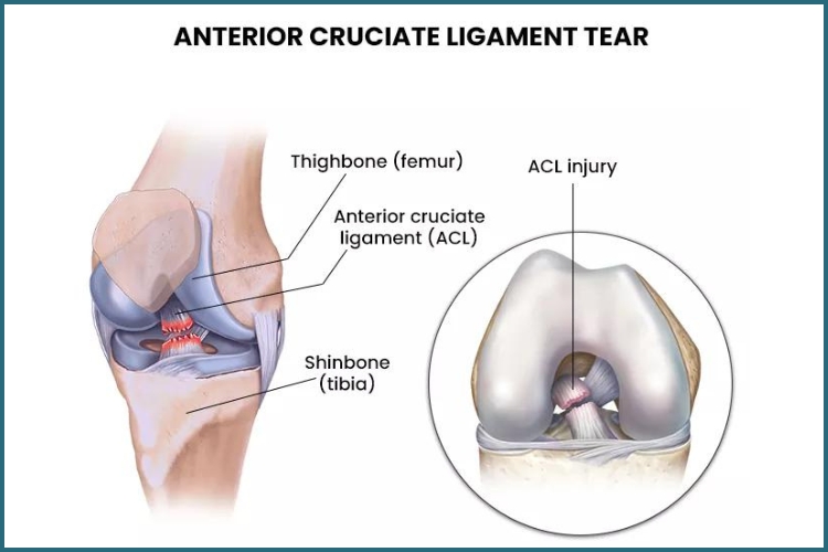 Anterior Cruciate Ligament ( ACL ) Tear - Fønixen Spine Pain